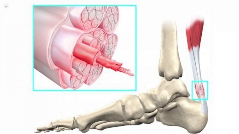 Causas de la tendinoplastia