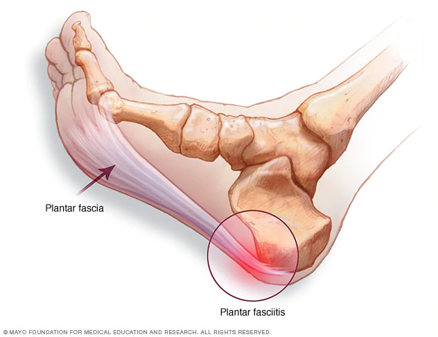 Fascitis plantar